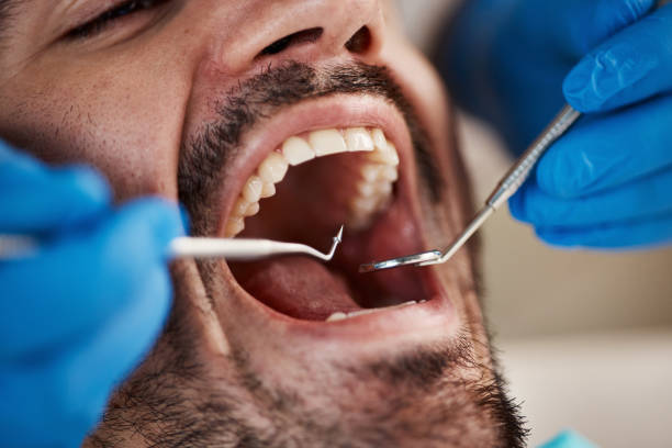 Best Broken or Cracked Tooth Emergency Dentist in Cottleville, MO